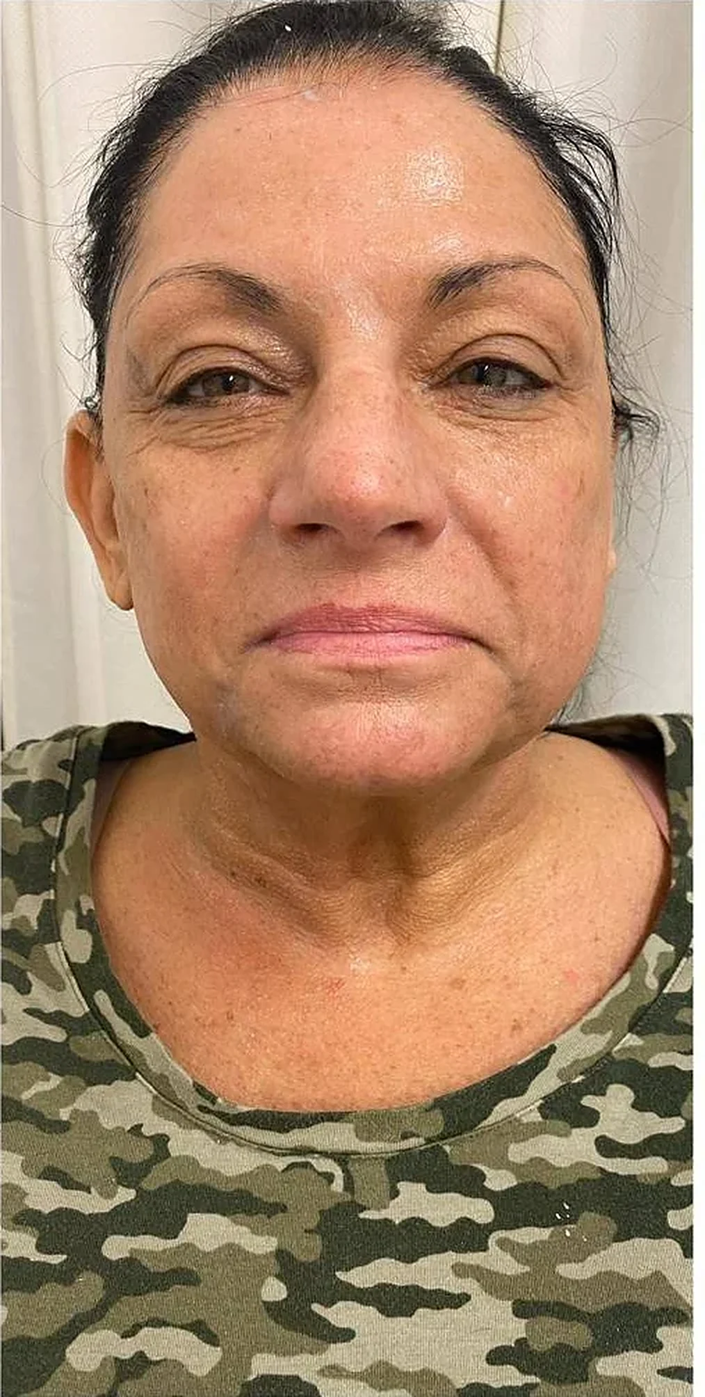 After — Jawline & neck