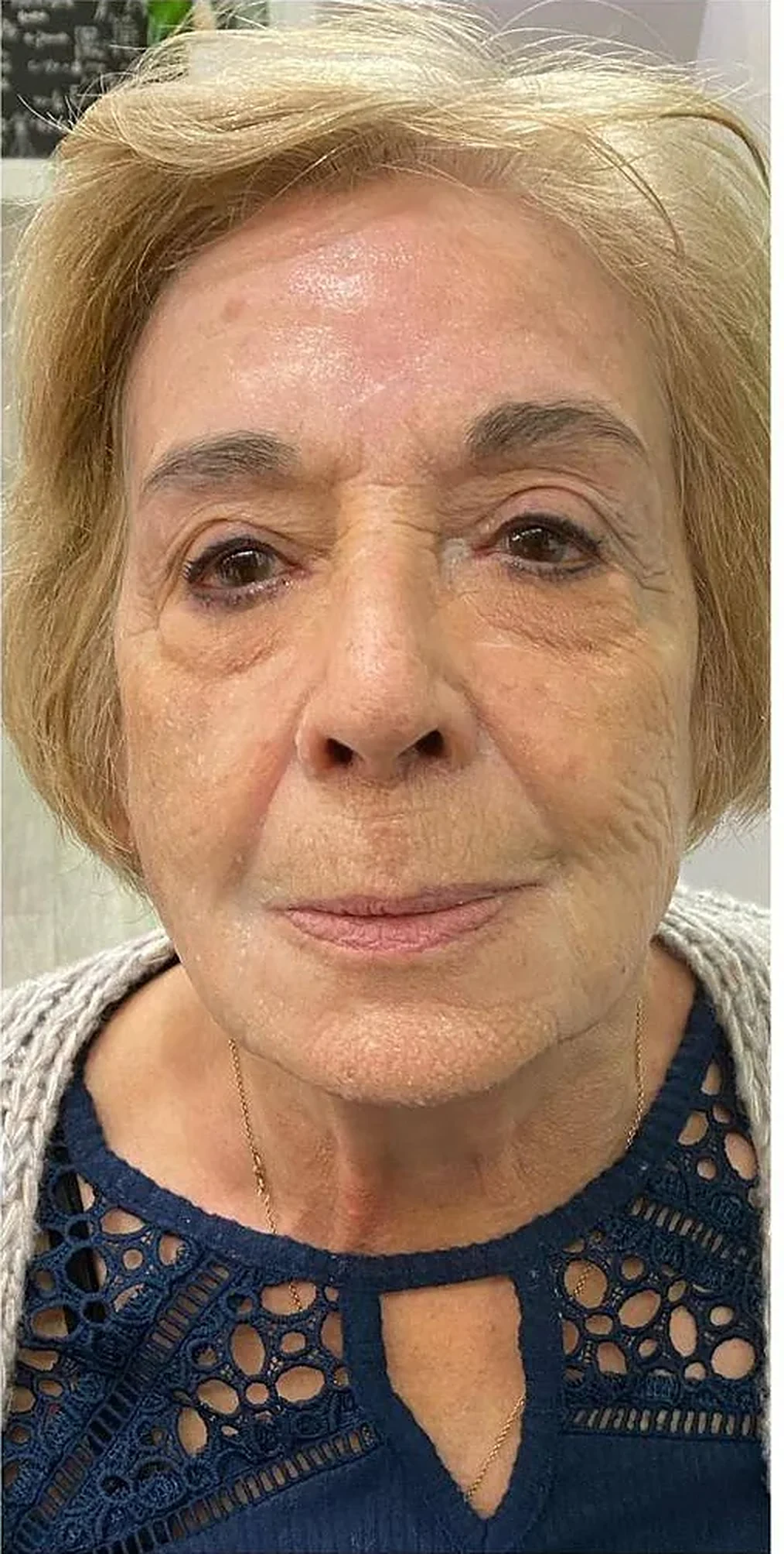 After treatment
