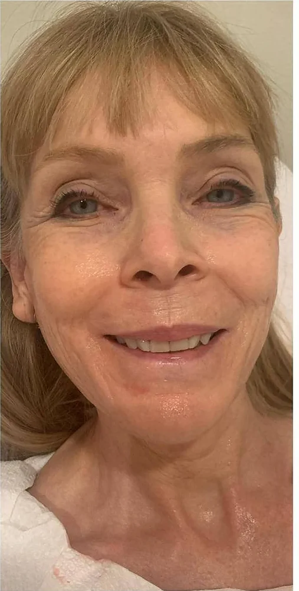 After — Crow's feet & glow