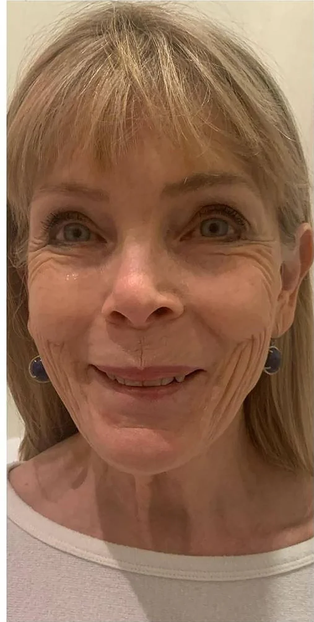 Before — Crow's feet & glow