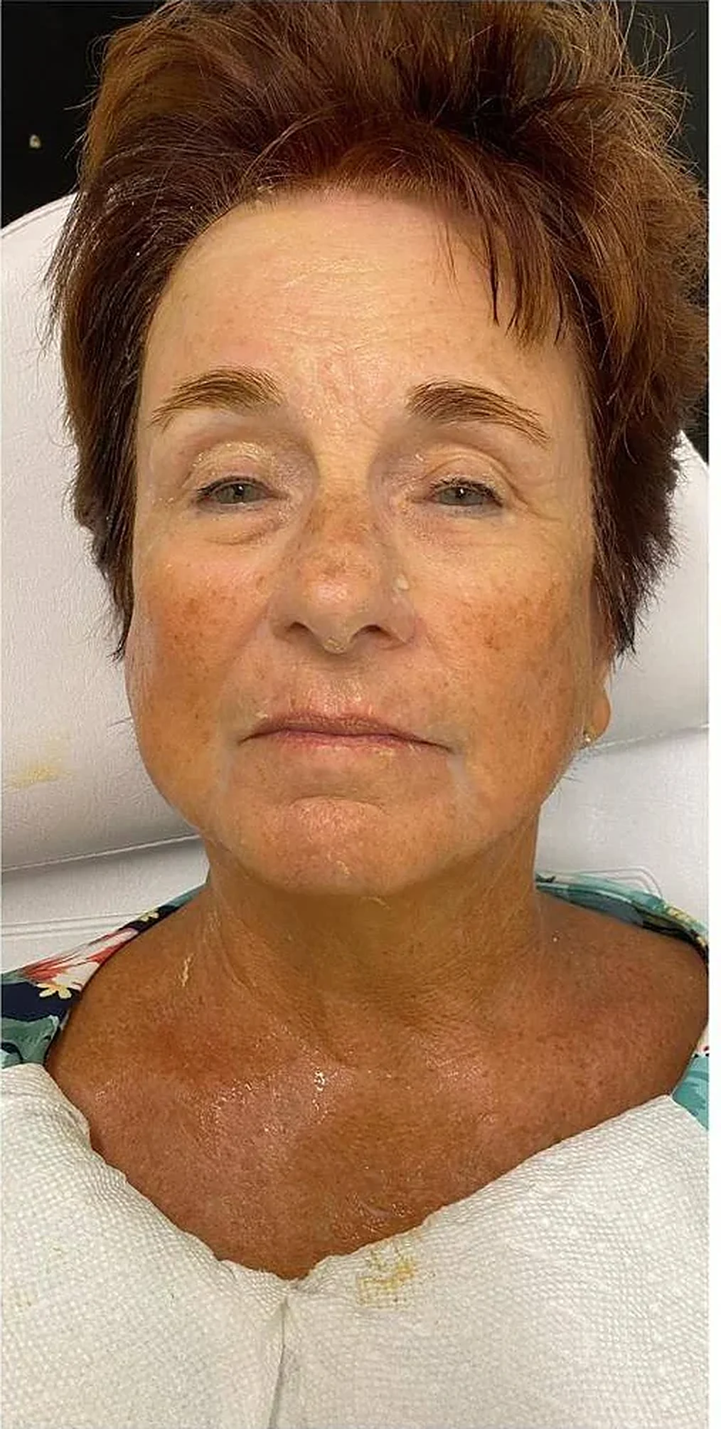 After — Overall rejuvenation