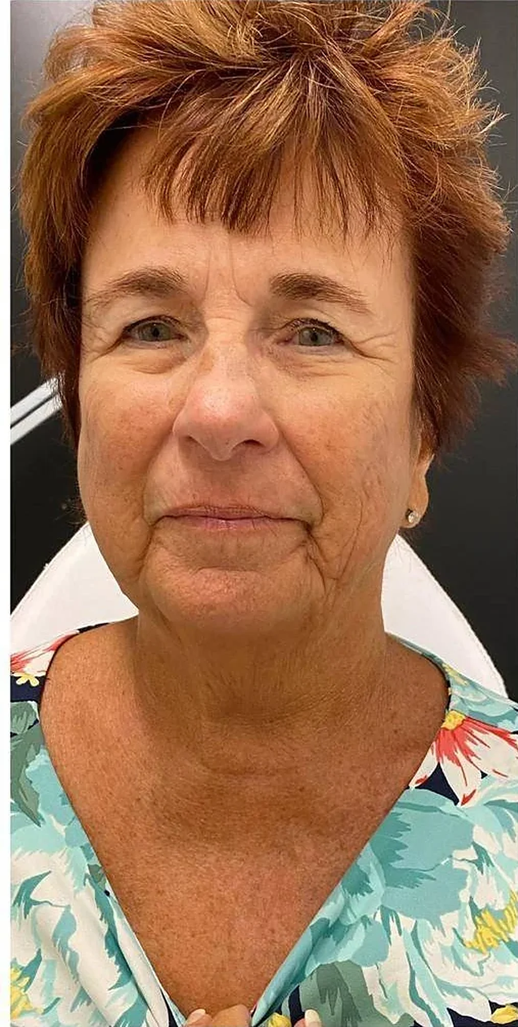 Before — Overall rejuvenation